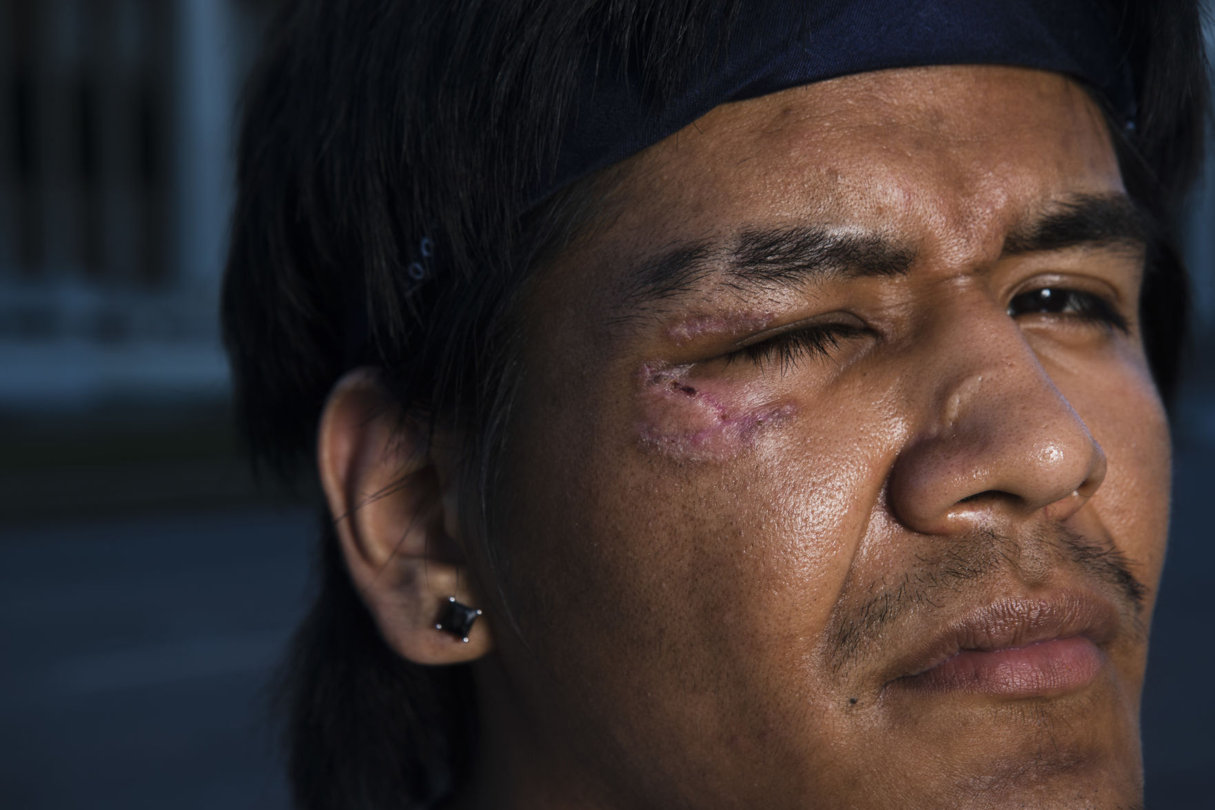 Protest injury 22013751A